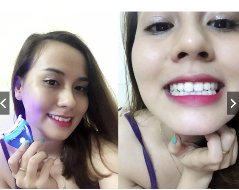 (Xả Kho) Set Tẩy Trắng Răng Tại Nhà White Light