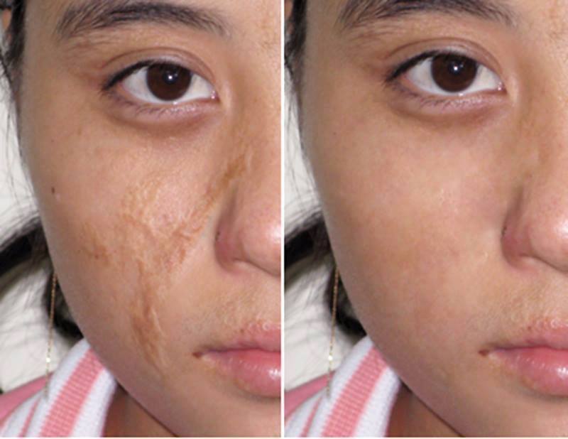 Kem Mờ Sẹo Nga Klirvin Cream 25g