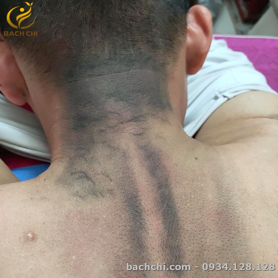 Bọ cạp sừng chân bạc Bách Chi - Đánh gió, giải cảm