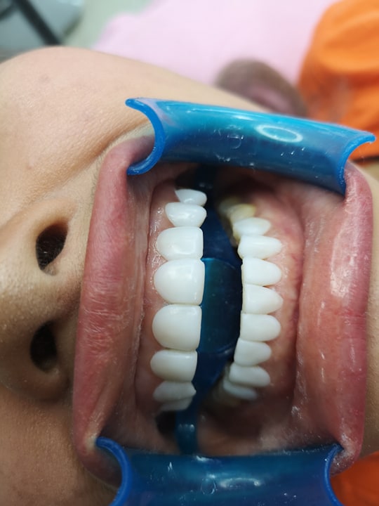 thuốc tẩy trắng răng philipin (bật tông cực trắng. không gây ê buốt)