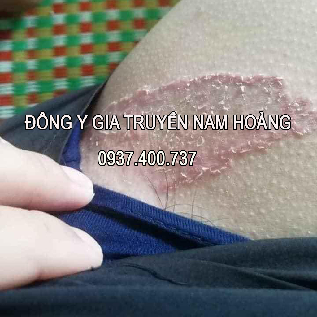 Thuoc Tri Benh Hac Lao Nam Hoang