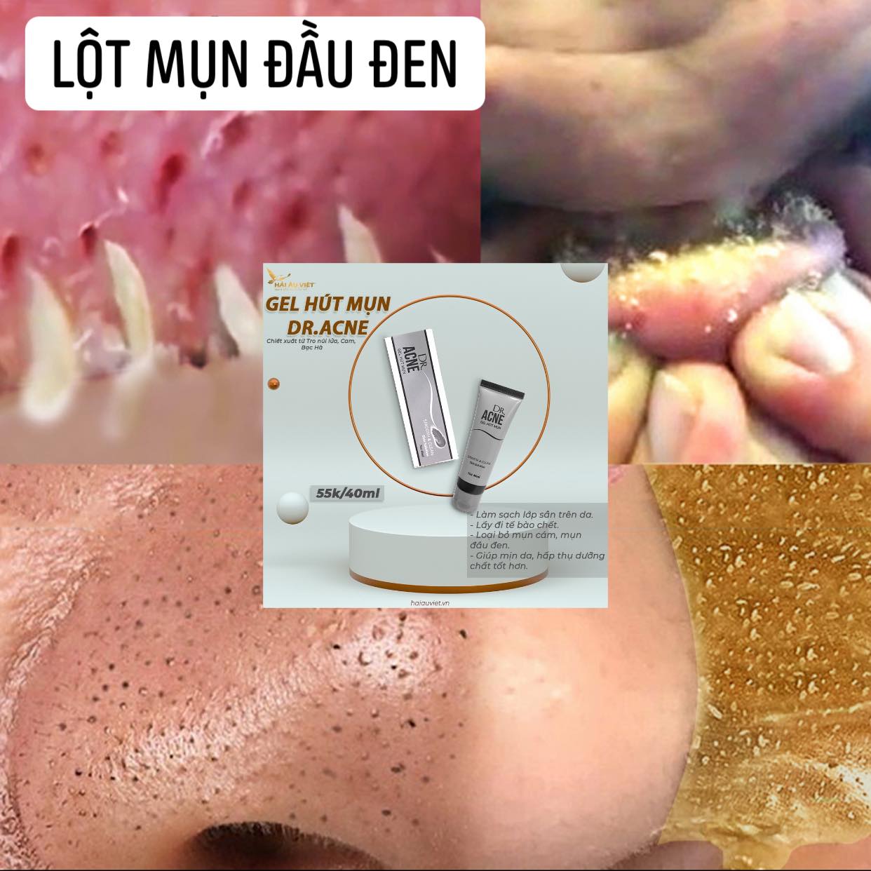 Gel lột mụn loại bỏ mụn đầu đen thu nhỏ lỗ chân lông cải thiện làn da xù xì mụn trứng cá mụn đầu đen