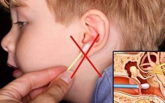Xịt tan ráy tai mivolis Đức