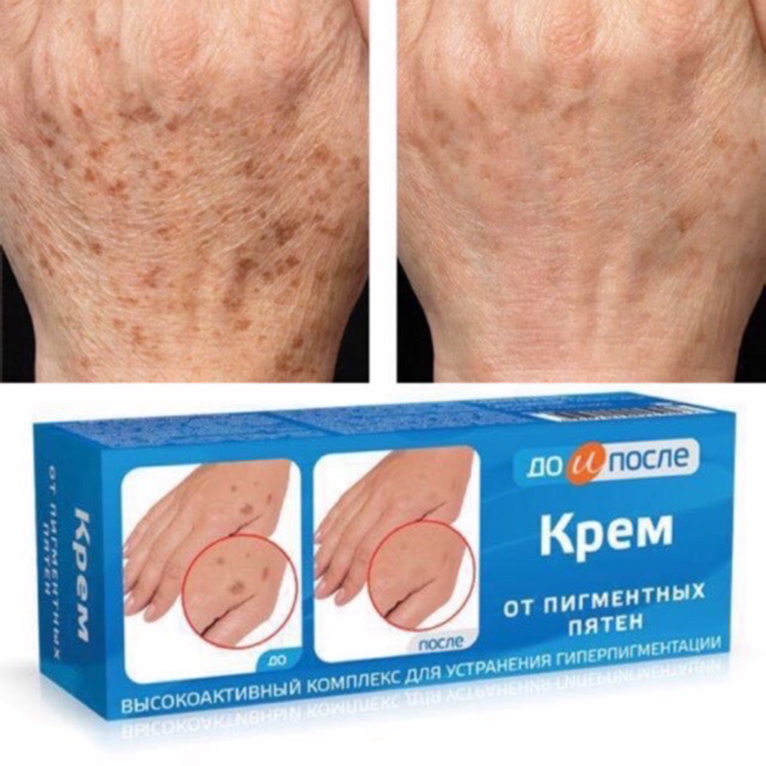 Kem bôi mờ đồi mồi Nga Kpem