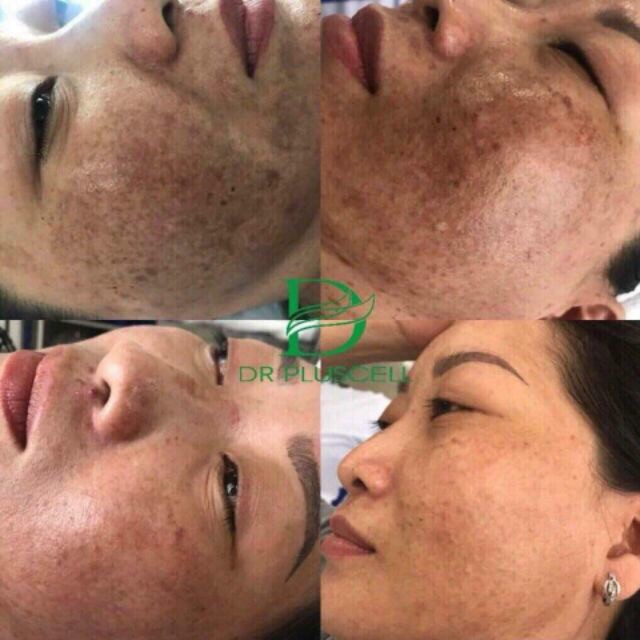 Tế bào gốc giảm nám, trắng da Dr VitaC