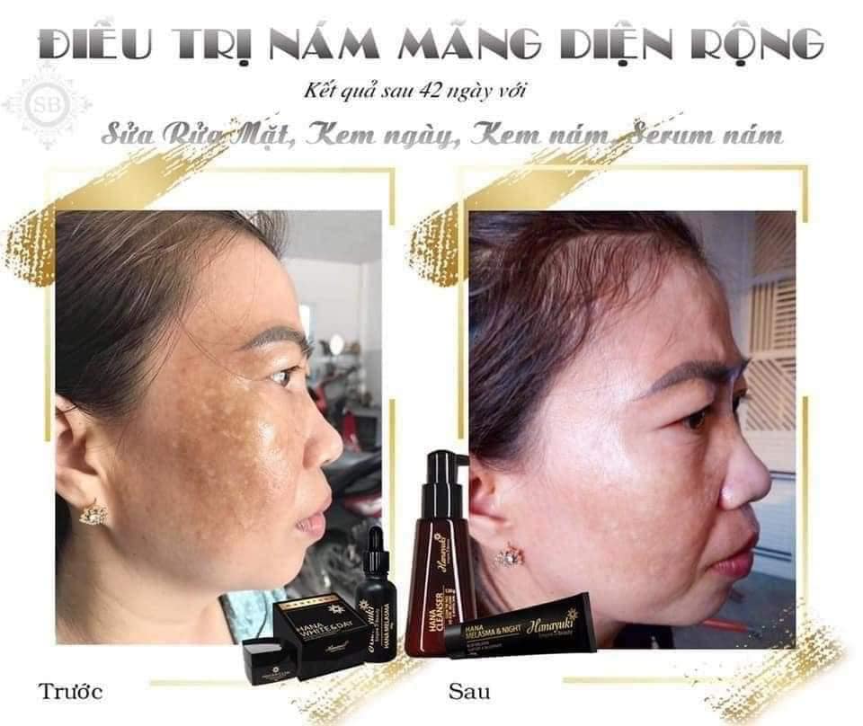 [HCM]Serum Nám Hanayuki