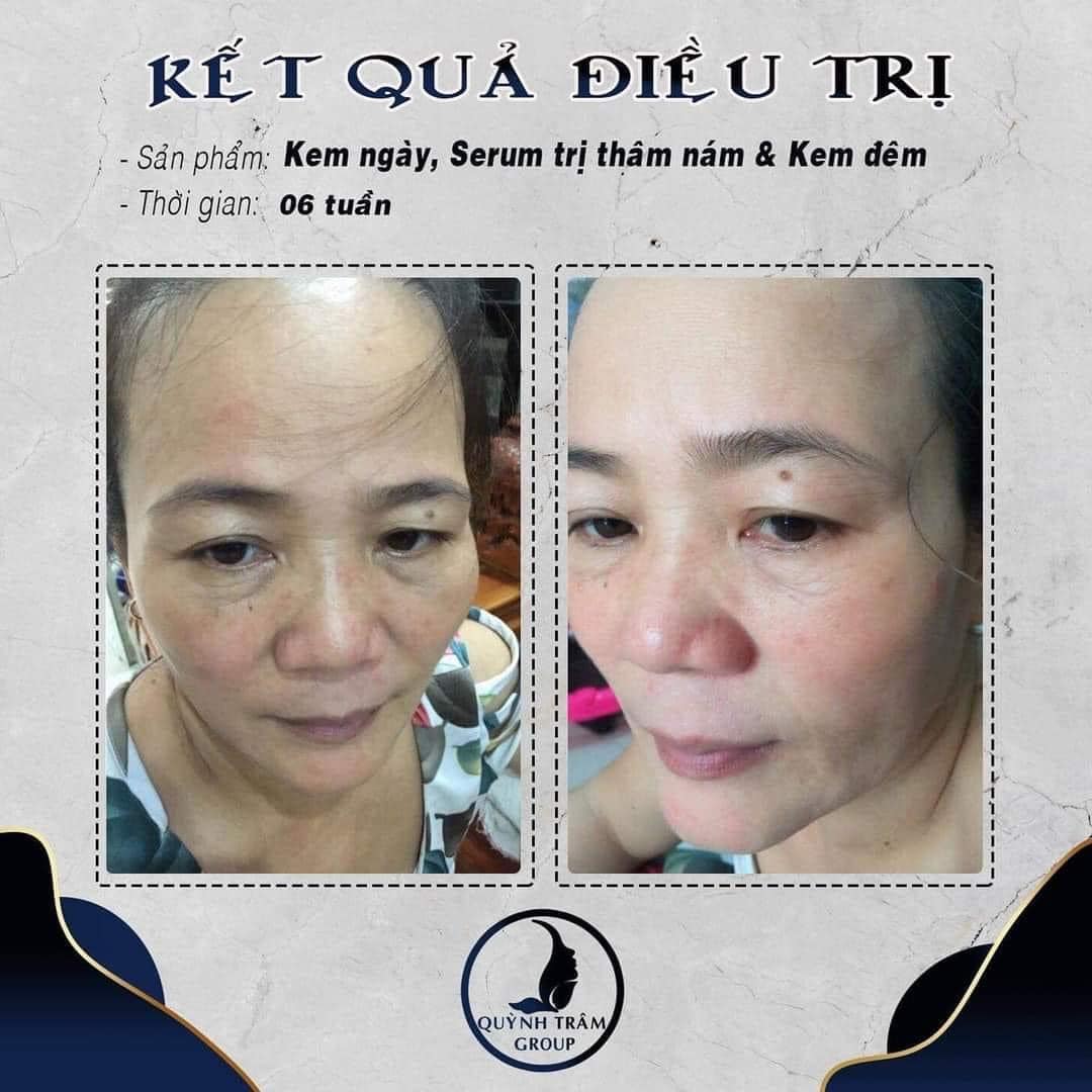 [HCM]Kem Nám Hanayuki