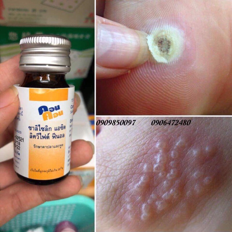 Chấm Mụn Cơm Mụn Cóc Concon Thái Lan