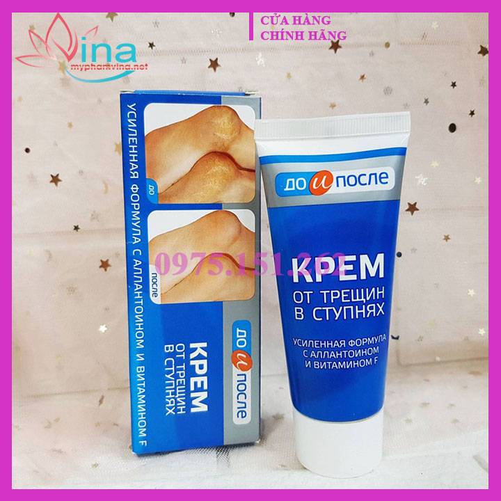 Kem nứt gót chân kpem 50ml - nga