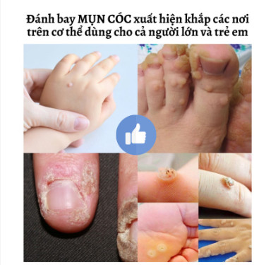 {ĐÁNH BẬT} MỤN CÓC, MỤN THỊT REMOVE EVERY WARTS