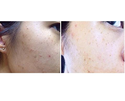 ACNE-AID BAR 100G