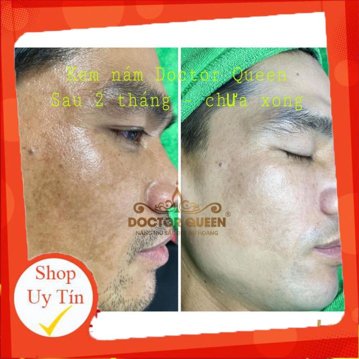 Kem Nám Doctor Queen-🔥𝐍𝐄𝐖🔥- (Ngừa Các Loại Nám,Sạm Da,Tàn Nhang,Làm Sáng Da,Đều Màu Da.,,)