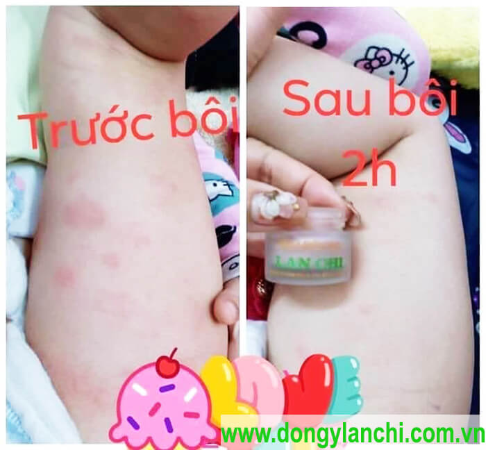 Kem Bôi Da Mộc Liễu Vương Lan Chi