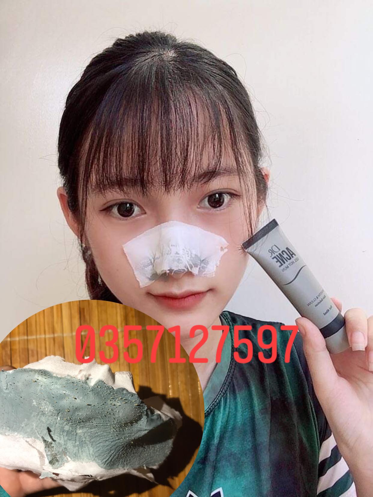 Gel lột mụn đầu đen mụn cám acne