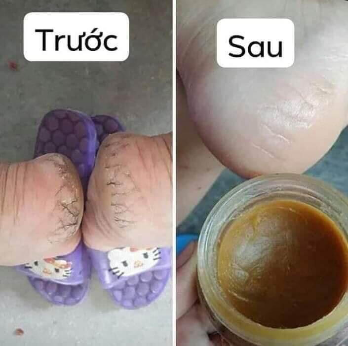 Cao lá trị nút nẻ
