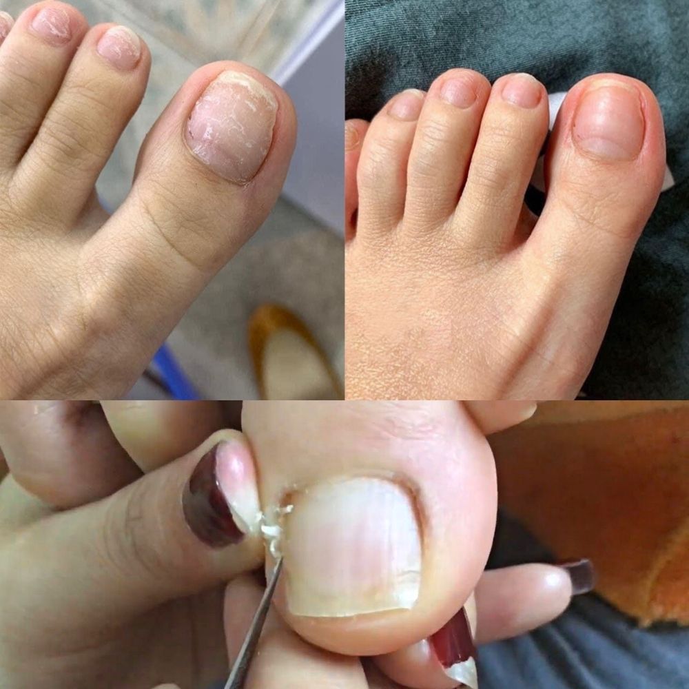 Cây lấy khóe móng chân cán gỗ