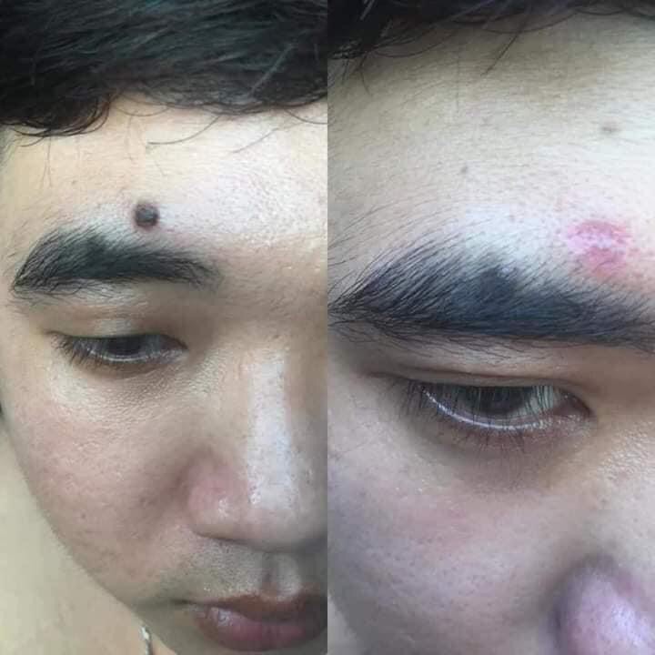 GEL TẨY NUỐT RUỒI NGA