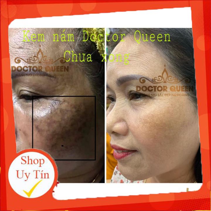 Kem Nám Doctor Queen-🔥𝐍𝐄𝐖🔥- (Ngừa Các Loại Nám,Sạm Da,Tàn Nhang,Làm Sáng Da,Đều Màu Da.,,)