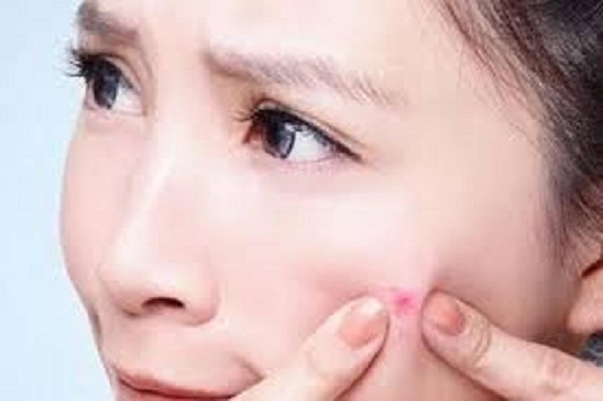 KEM MỤN THẢO DƯỢC MẸ KEN-30ml