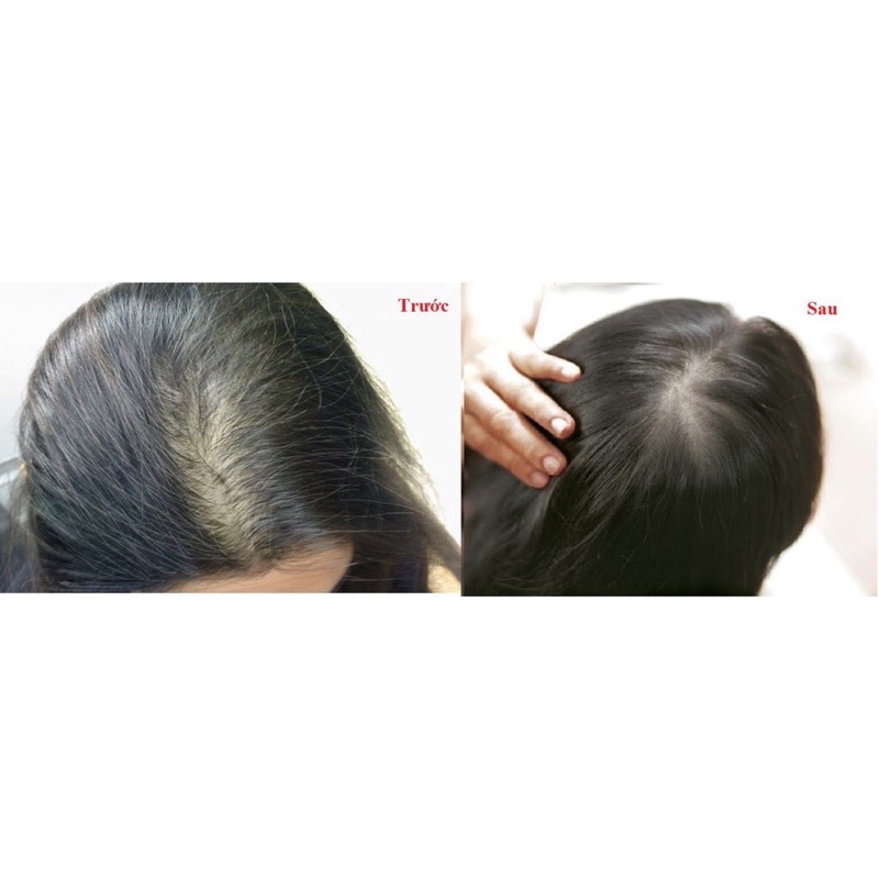 Tinh Chất Mọc Tóc Radical Med 5ml Cho Nữ