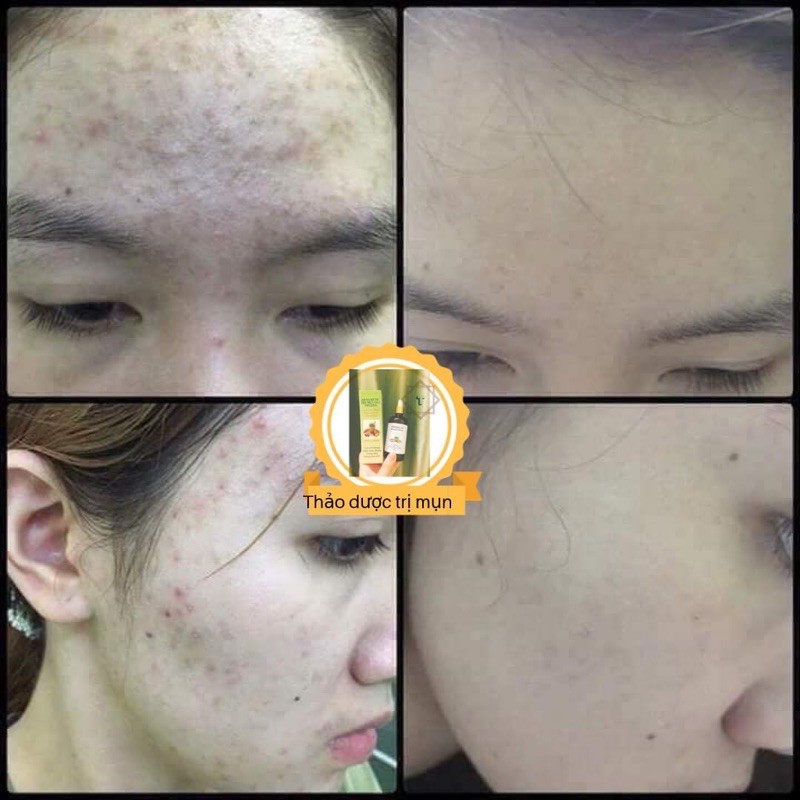 THẢO DƯỢC MT SẠCH MỤN THÂM RỖ TRIỆT ĐỂ (50ML)