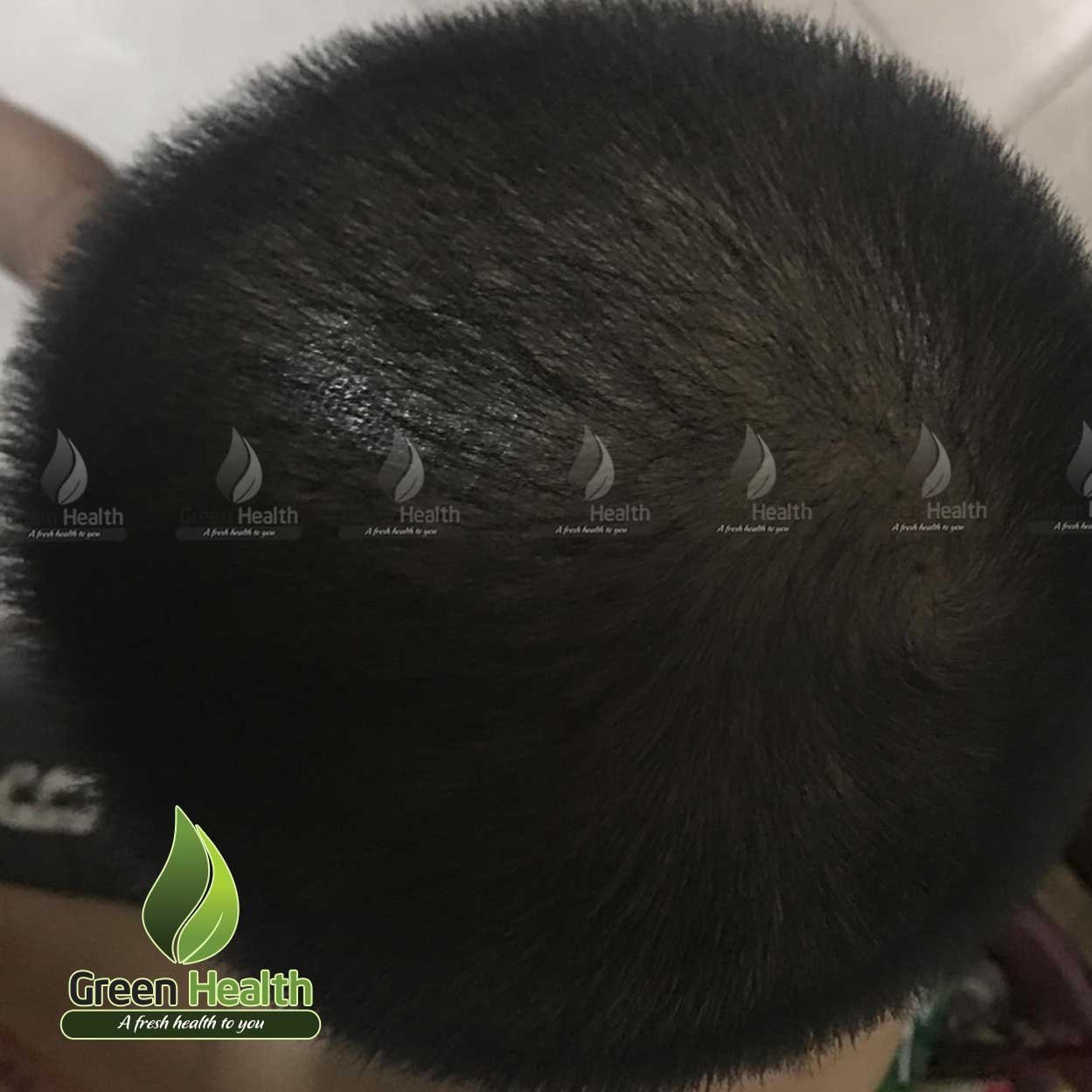 DHT HairOmega Biotin Thực Phẩm Bổ Sung Đẹp Da Tóc Móng Hàng Nhập Mỹ Cải Thiện Tình Trạng Tóc Rụng Hói Đầu Cho Bạn Mái Tóc Bóng Khỏe Dày Dặn Kích Thích Tóc