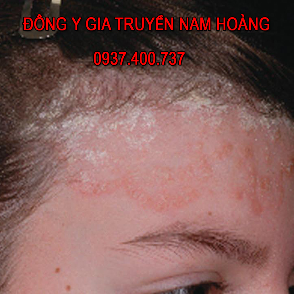 Dược Phẩm Trị Bệnh Nấm Da Đầu Nam Hoàng