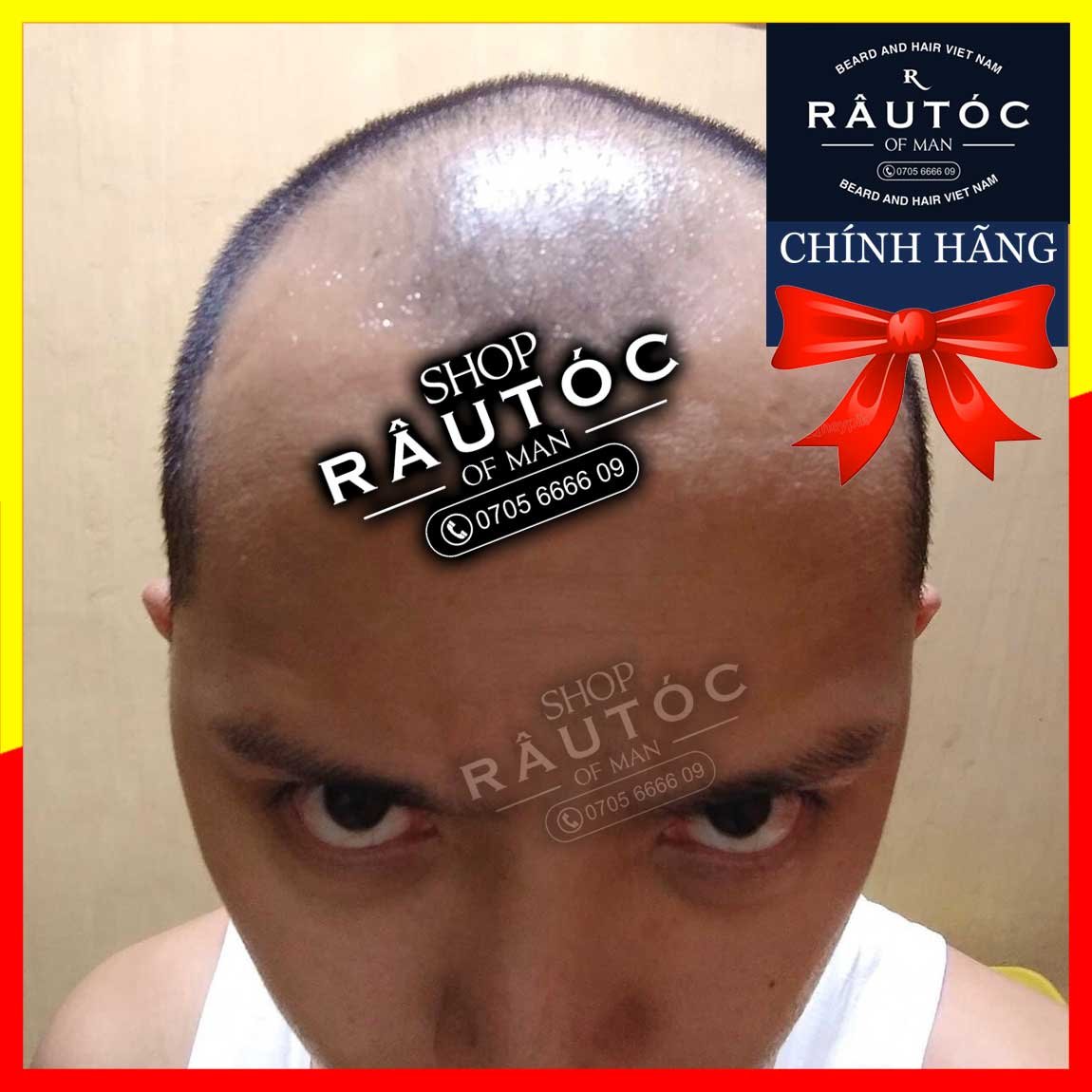 PEO MIX pha vào Minoxidil 5%