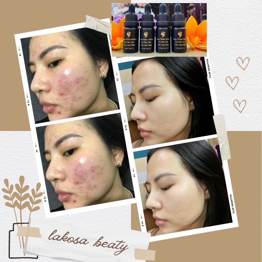 Serum Mụn Ẩn Mụn Đầu Đen Mụn Thâm Cho Da Dầu 10ml .