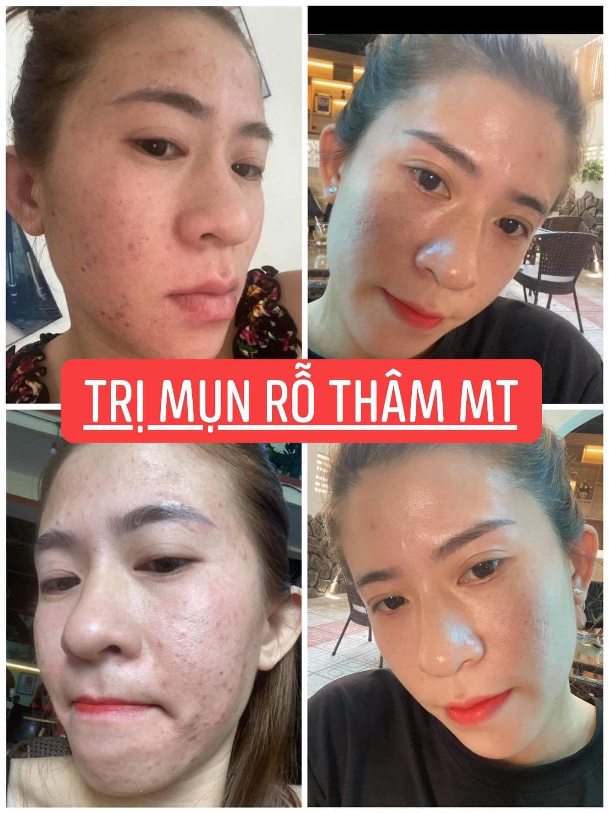 Compo 2 lọ Thảo Dược Sạch Mụn MT (100ml)