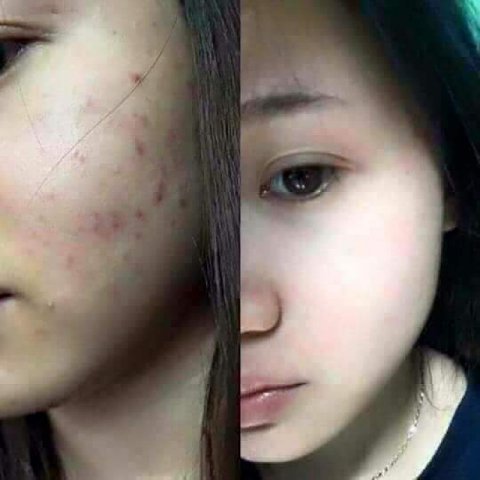 Tinh Chất Mụn Linh Hương Purity Skin (cam kết chính hãng)