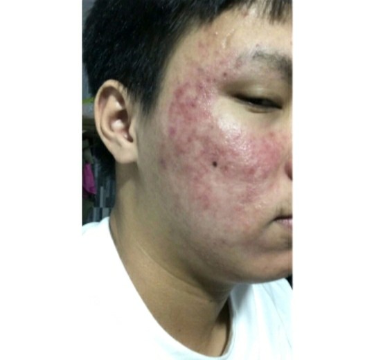 SERUM THẢO DƯỢC NHÂN SÂM SẠCH MỤN MAY NEW 50ML