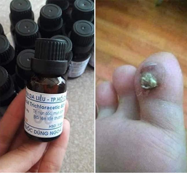 Mụn Cơm Mụn Cóc Mắt Cá Chân Vết Chai Sần