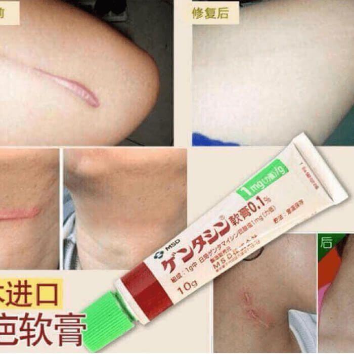 Kem xóa sẹo Gentacin Nhật Bản