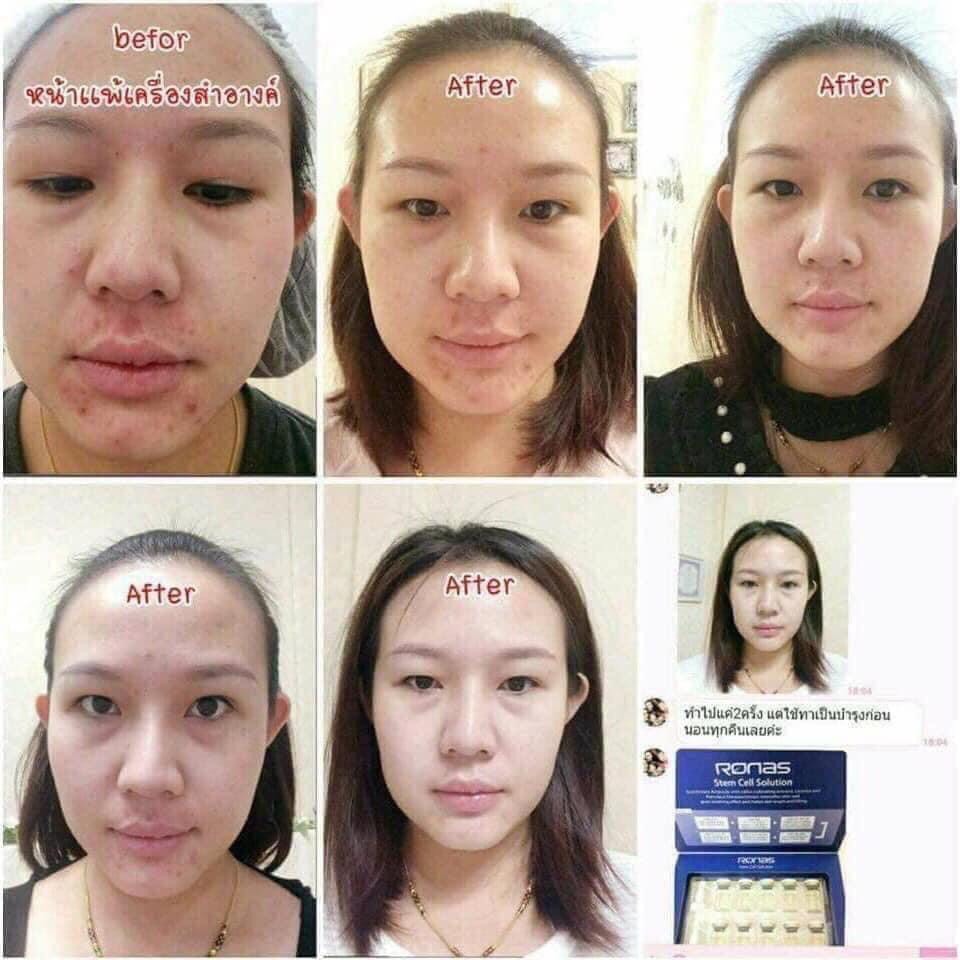 [Tế bào gốc]. 340.000đ/ hộp 10 ống. Tế bào gốc Ronas.