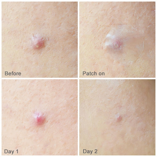 Miếng dán mụn Cosrx Acne Pimple Master Patch 24 miếng 1 gói