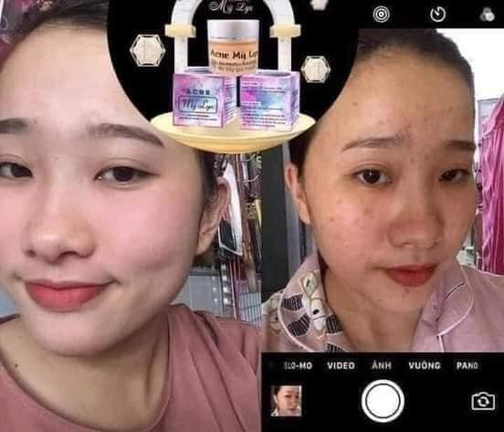 Kem Acne Mỹ Lyn 5gram (Hủ nhỏ vuông)