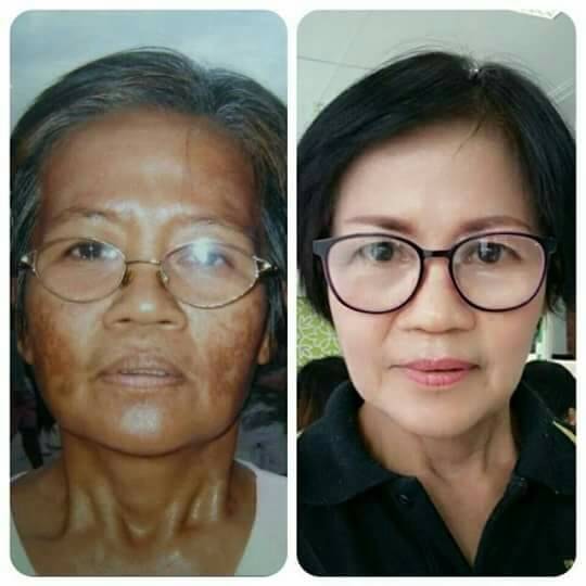Serum trắng da, mờ thâm - nám - tàn nhang - Willendrof Melasma Serum 20ml