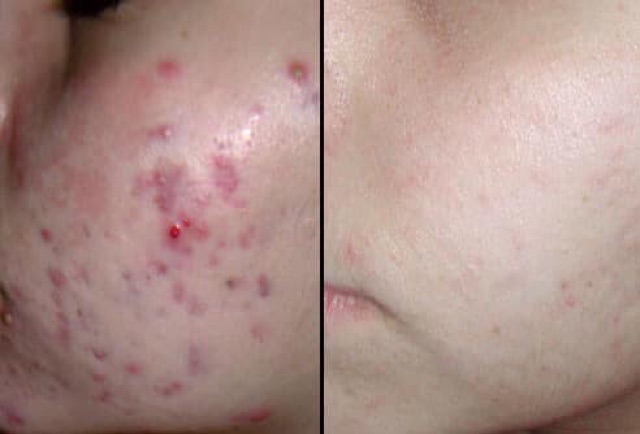 Tế Bào Gốc Giảm Mụn Thâm Reborn