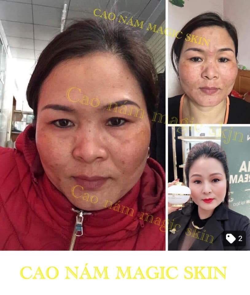 KEM NGỪA NÁM TAN NHANG MAGIC SKIN
