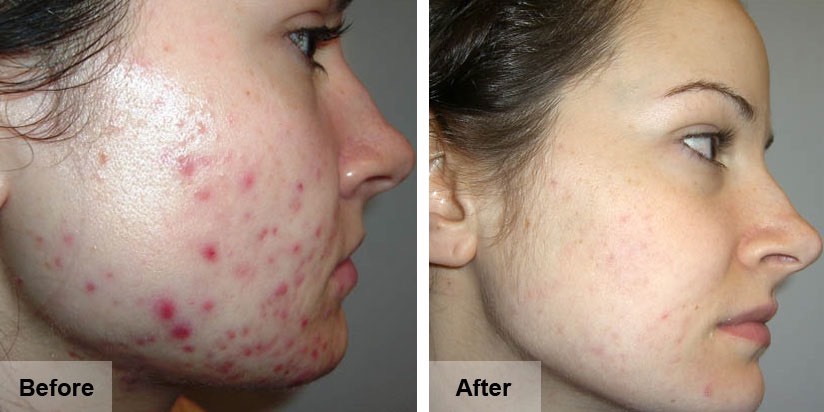 NeoStrata Oily Skin Solution AHA 8 – Dung Dịch Trị Mụn Kiểm Soát Nhờn