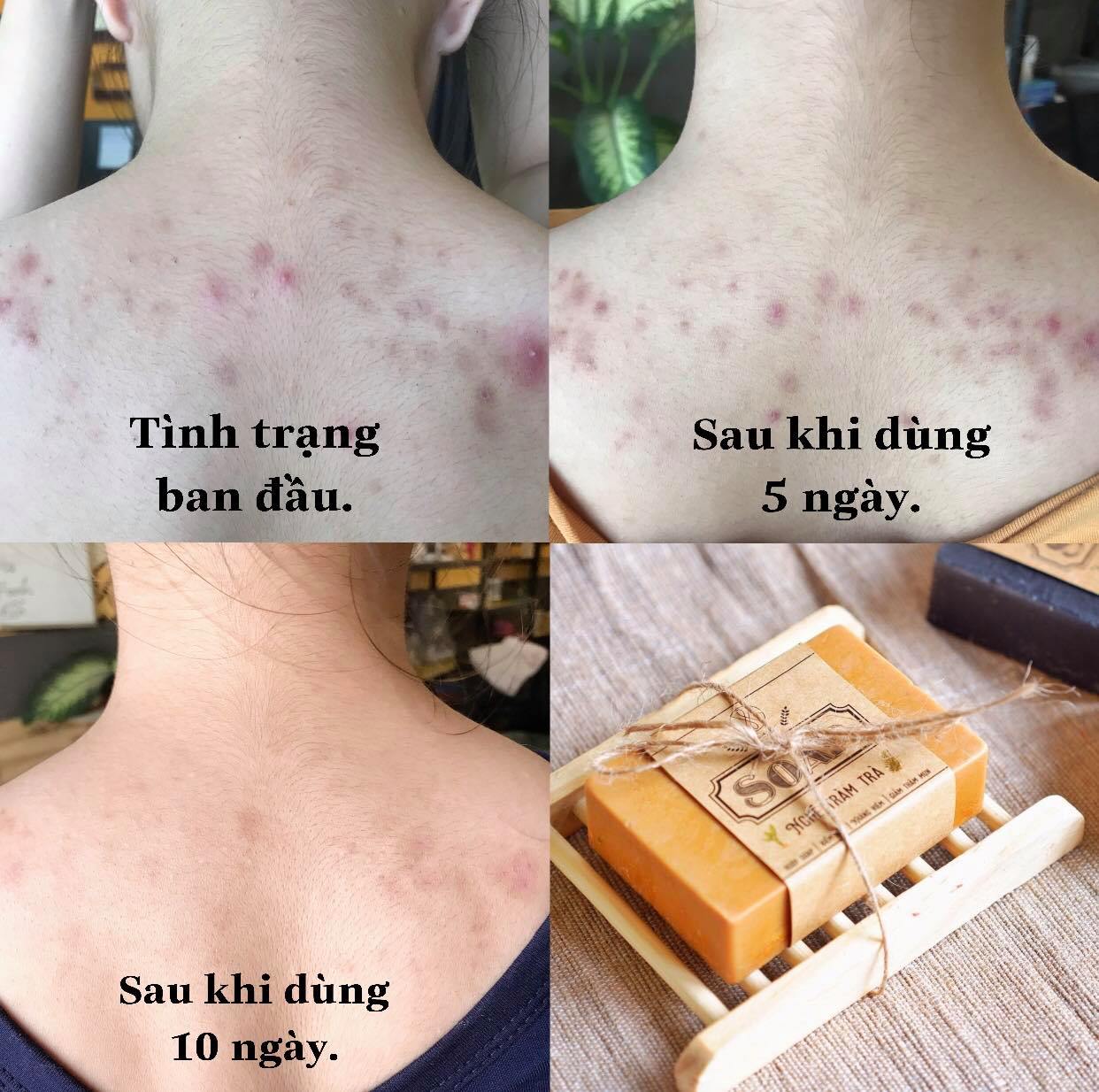 Soap nghệ - tràm trà giải quyết mụn lưng