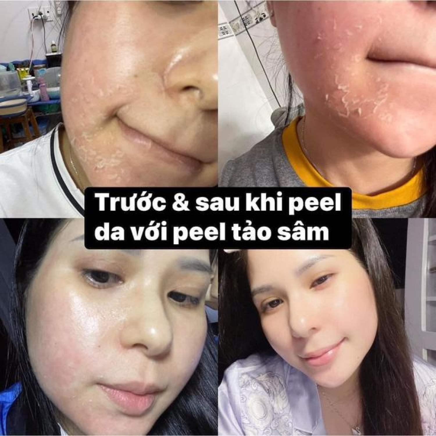 PEEL DA TẢO SÂM 36 VỊ - BÓC TÁCH TẢO SÂM ĐÔNG Y