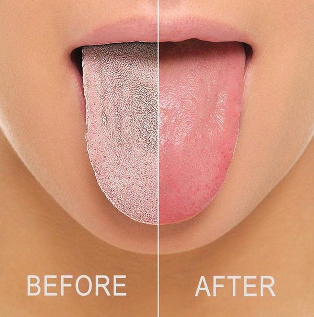 dụng cụ cạo lưỡi bằng thép không gỉ