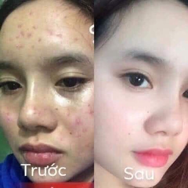[HCM]Combo kem A Face Pháp + Detox Bọt Biển