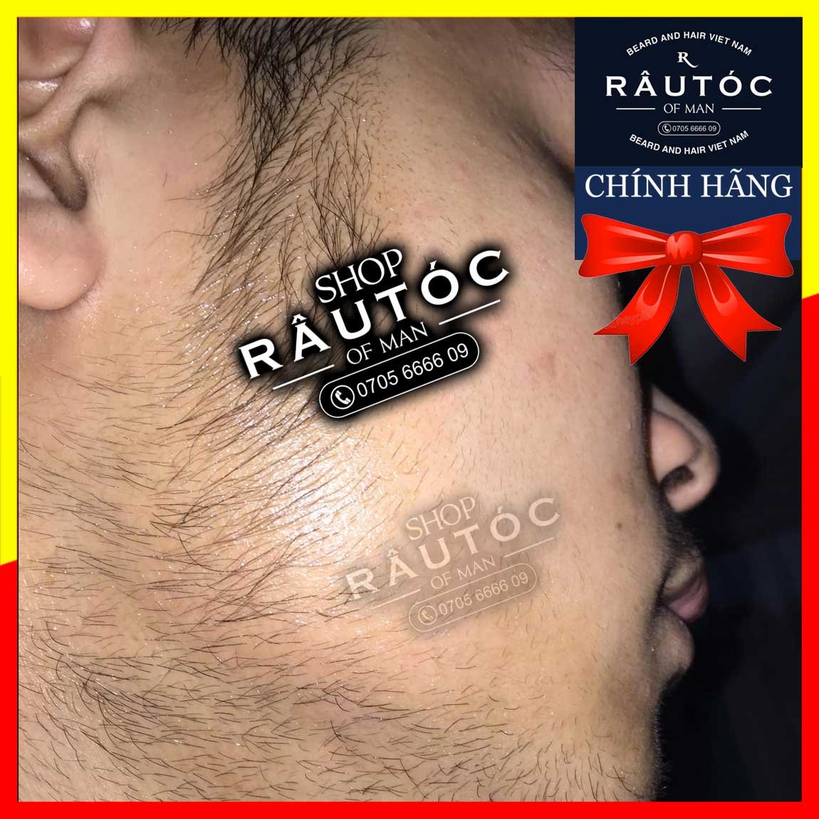 [HCM]RETINOL mix vào Minoxidil hỗ trợ mọc râu tóc
