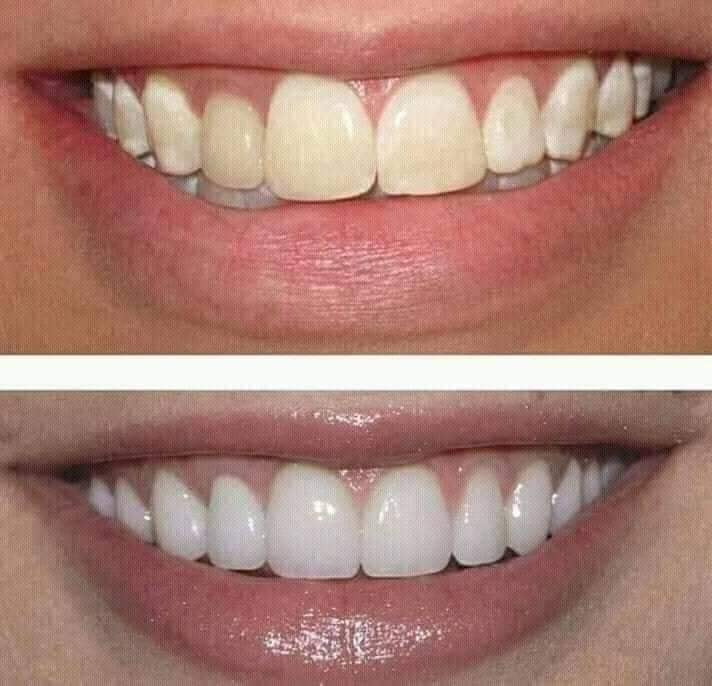 Bột trắng răng thảo mộc 37