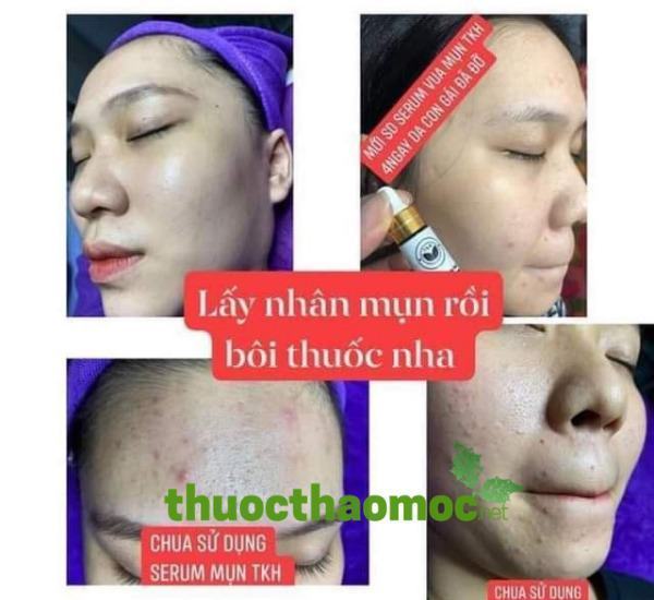 Serum Mụn Trần Kim Huyền
