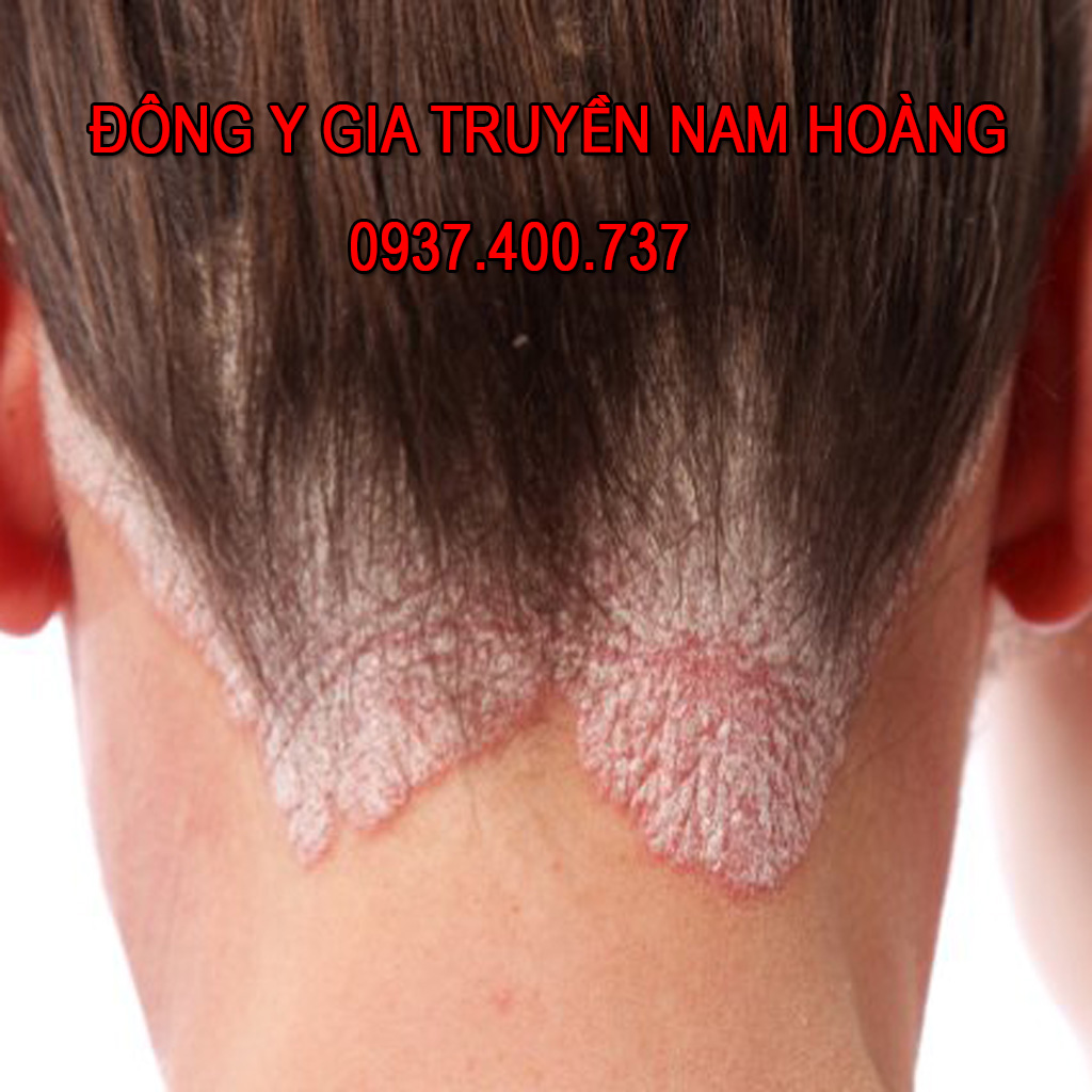 Dược Phẩm Trị Bệnh Nấm Da Đầu Nam Hoàng