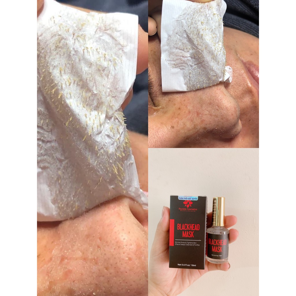 Miễn Phí Ship. Lột Mụn Đầu Đen BLACKHEAD MASK